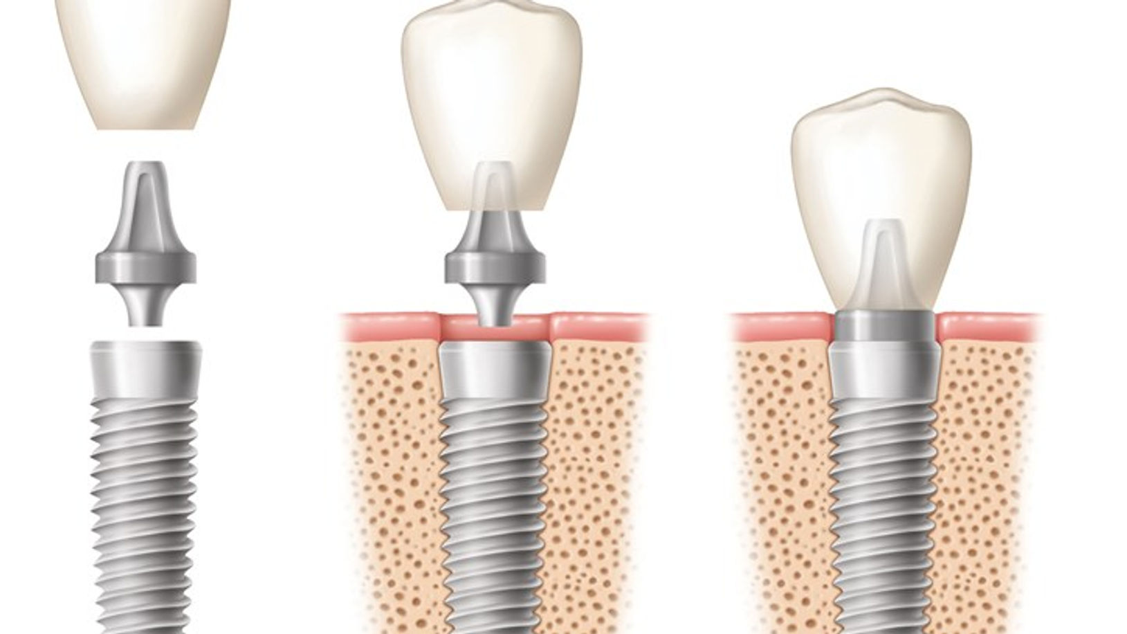 Dental Implants
